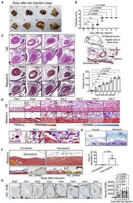 Unique Angiogenesis From Cardiac Arterioles During Pericardial Adhesion Formation